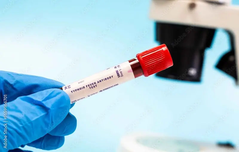 Understanding Typhoid Fever Symptoms, Causes, and Prevention